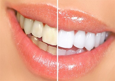 Health: 10 reasons to yellow teeth